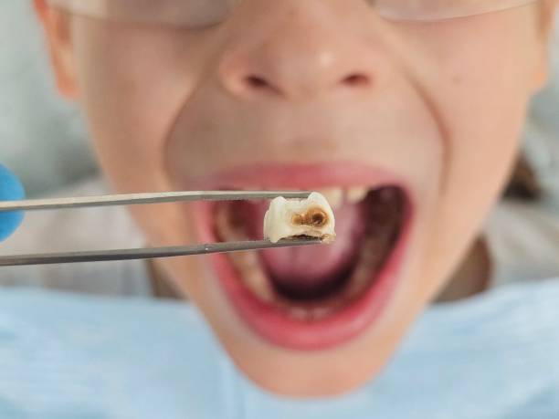 Best Emergency Dental Extractions in Corralitos, CA